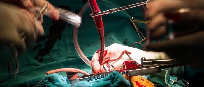 Pós-operatório de cirurgia cardíaca: principais dúvidas - Dr. Edilberto  Castilho